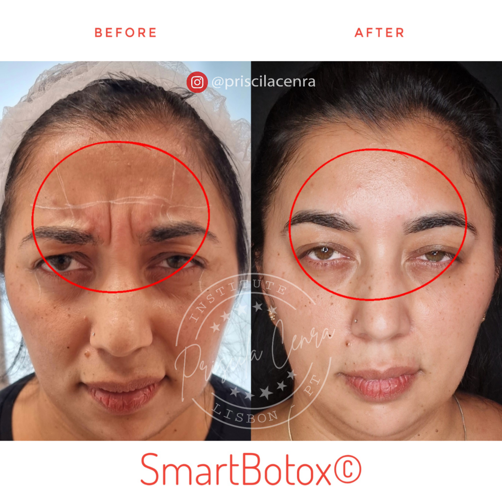 Botox Portugal